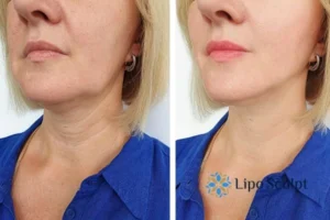 Double chin before and after Hi-Fu treatment 4 Book your double chin treatment Staveley today! We are here to help!