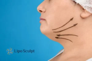 Double chin before and after Hi-Fu treatment 3 Boost your confidence with a Double chin treatment Staveley