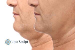 Double chin before and after Hi-Fu treatment 2 Double chin treatment Staveley from Lipo Sculpt - feel more confident today!