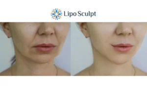 Explaining Total Skin Tightening Treatment And What It Can Do For You 2 Do you want to boost your self confidence? Give Morpheus8 Staveley a try today!
