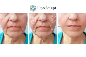 Explaining Total Skin Tightening Treatment And What It Can Do For You 3 Boost your confidence with Morpheus8 Staveley call our team today!