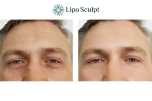 Explaining Total Skin Tightening Treatment And What It Can Do For You 6 Morpheus8 Staveley book in today to find out more!