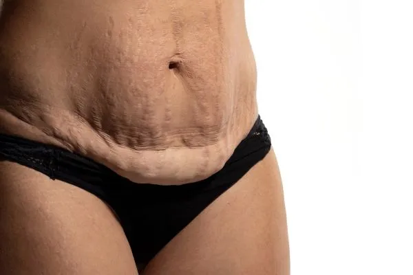 Lost the Weight but Not the Loose Skin? 1 image of womans stomach after weight loss showing loose skin Staveley